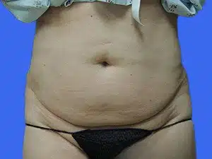 Tummy Tuck before and after photos Tummy Tuck before and after photos