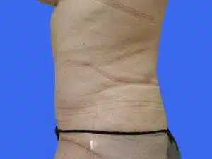 Tummy Tuck before and after photos Tummy Tuck before and after photos