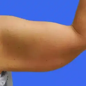 Arm Lift