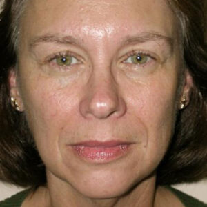 Face Lift before and after photos
