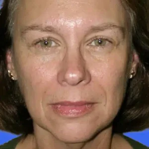 Face Lift before and after photos