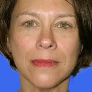 Face Lift before and after photos