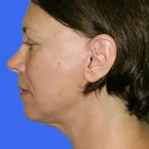 Face Lift before and after photos