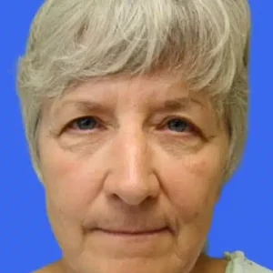 Eyelid Surgery before and after photos