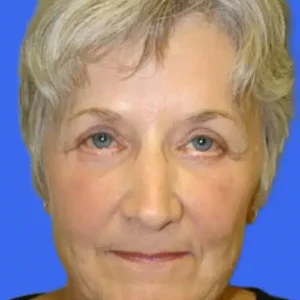 Eyelid Surgery before and after photos