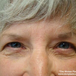 Eyelid Surgery before and after photos