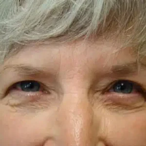 Eyelid Surgery before and after photos