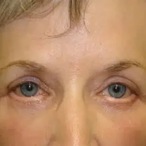 Eyelid Surgery before and after photos