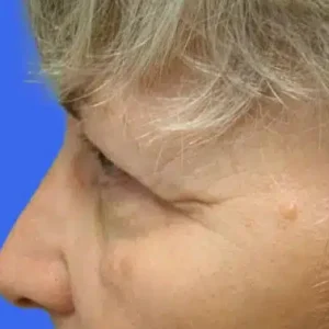 Eyelid Surgery before and after photos