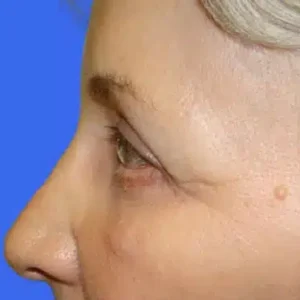 Eyelid Surgery before and after photos