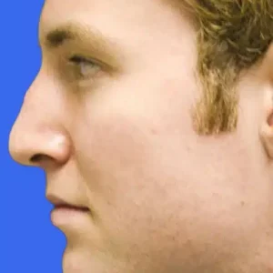 Rhinoplasty before and after photos