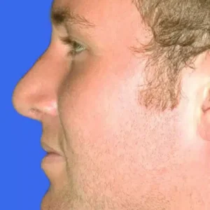 Rhinoplasty before and after photos