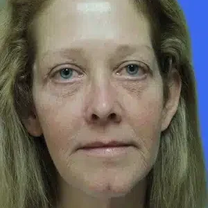 Laser Skin Resurfacing before and after photos
