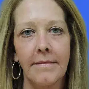 Laser Skin Resurfacing before and after photos