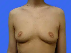 Breast Augmentation before and after photos Breast Augmentation before and after photos