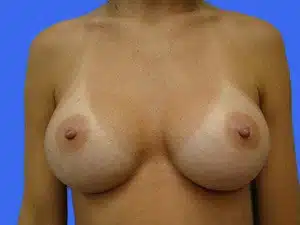 Breast Augmentation before and after photos Breast Augmentation before and after photos