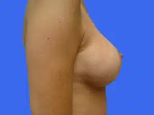 Breast Augmentation before and after photos Breast Augmentation before and after photos