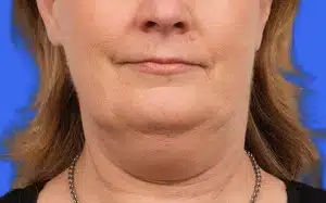 CoolSculpting before and after photos CoolSculpting before and after photos