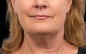 CoolSculpting before and after photos