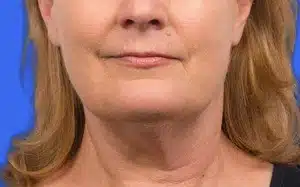 CoolSculpting before and after photos CoolSculpting before and after photos