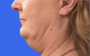 CoolSculpting before and after photos CoolSculpting before and after photos