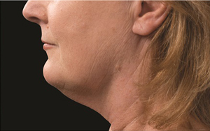 CoolSculpting before and after photos