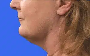 CoolSculpting before and after photos CoolSculpting before and after photos