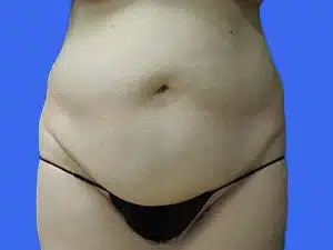 Tummy Tuck before and after photos Tummy Tuck before and after photos