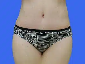 Tummy Tuck before and after photos Tummy Tuck before and after photos