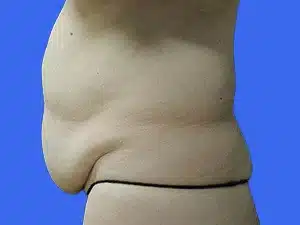 Tummy Tuck before and after photos Tummy Tuck before and after photos