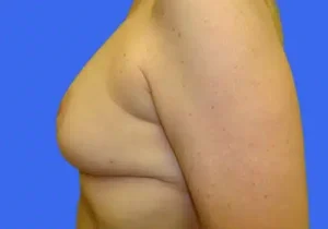 Breast Lift before and after photos Breast Lift before and after photos