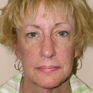 Face Lift before and after photos