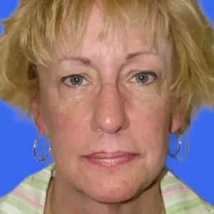 Face Lift before and after photos