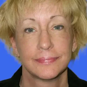 Face Lift before and after photos