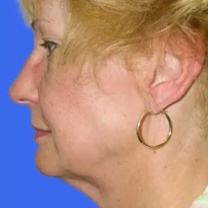 Face Lift before and after photos