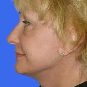 Face Lift before and after photos