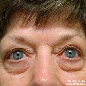 Eyelid Surgery before and after photos