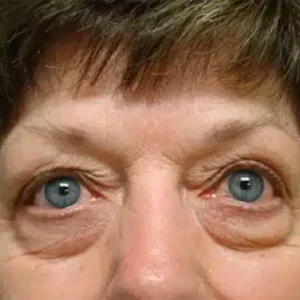 Eyelid Surgery before and after photos