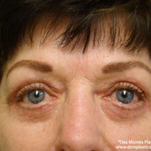 Eyelid Surgery before and after photos