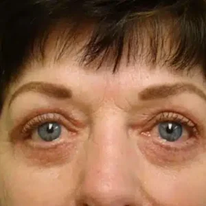 Eyelid Surgery before and after photos