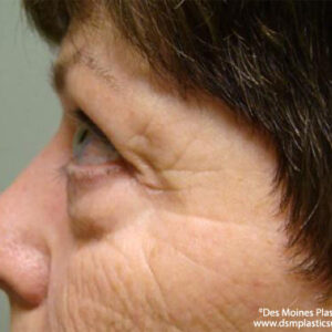 Eyelid Surgery before and after photos