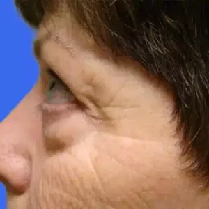 Eyelid Surgery before and after photos