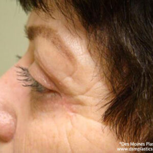 Eyelid Surgery before and after photos