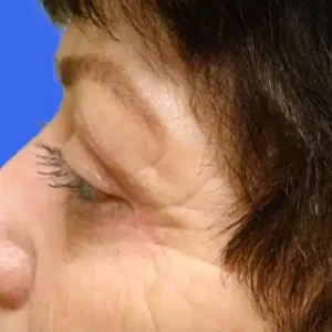 Eyelid Surgery before and after photos
