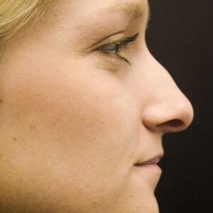 Rhinoplasty before and after photos