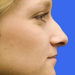 Rhinoplasty before and after photos