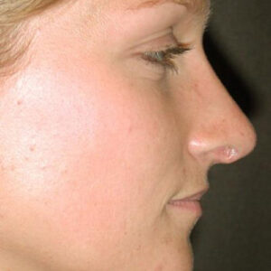 Rhinoplasty before and after photos