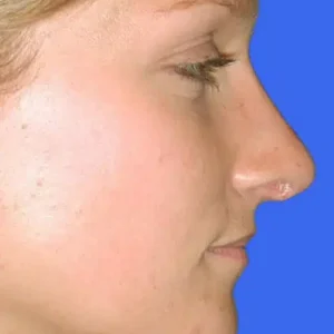 Rhinoplasty before and after photos