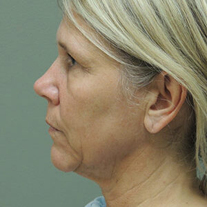 Laser Lift before and after photos