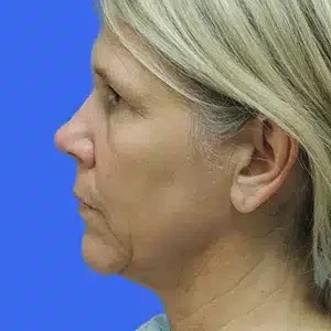 Laser Lift before and after photos